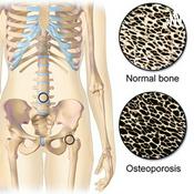 Podcast Osteoporosis Podcast